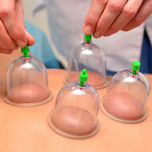 cupping-01 courtenay massage